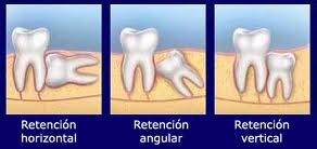 CIRUGIA DE CORDALES DESDE 60.000 